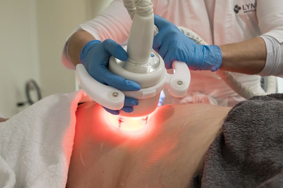 tratamiento marcacion abdominal