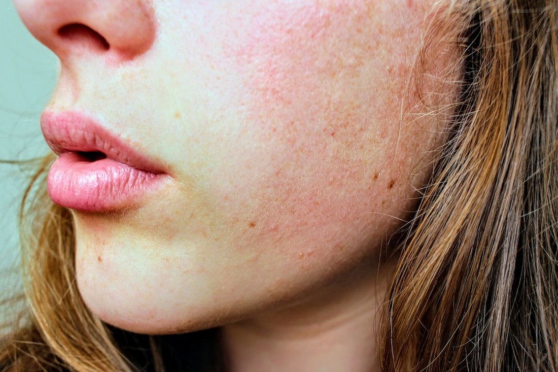mejor tratamiento facial renovar piel despues del verano