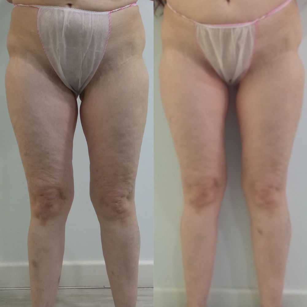 resultados presoterapia en piernas