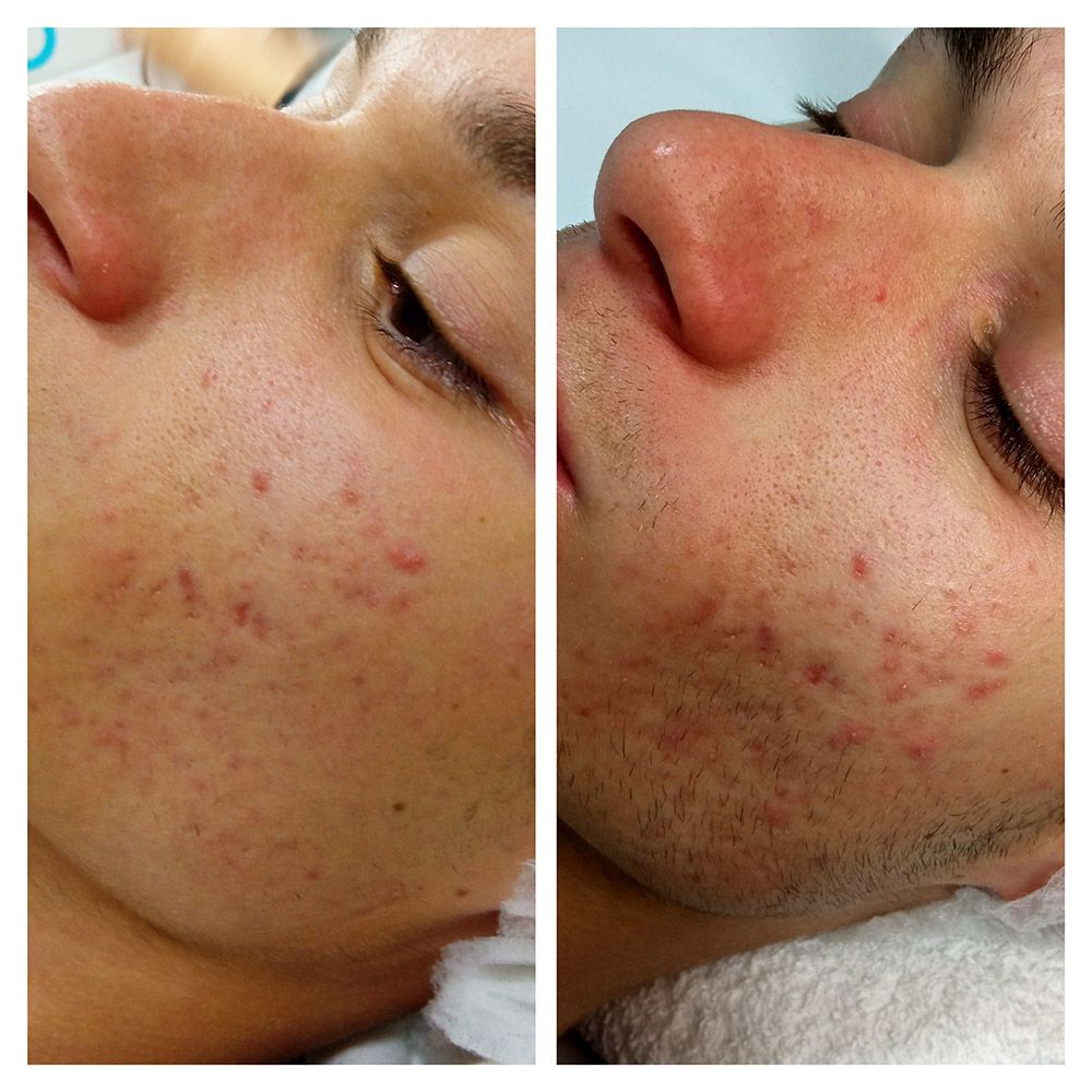 dermapen acne facial antes y despues