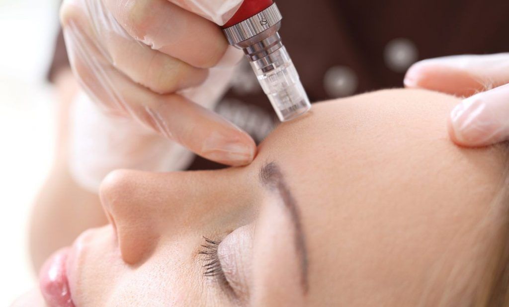 resultados dermapen antes y despues