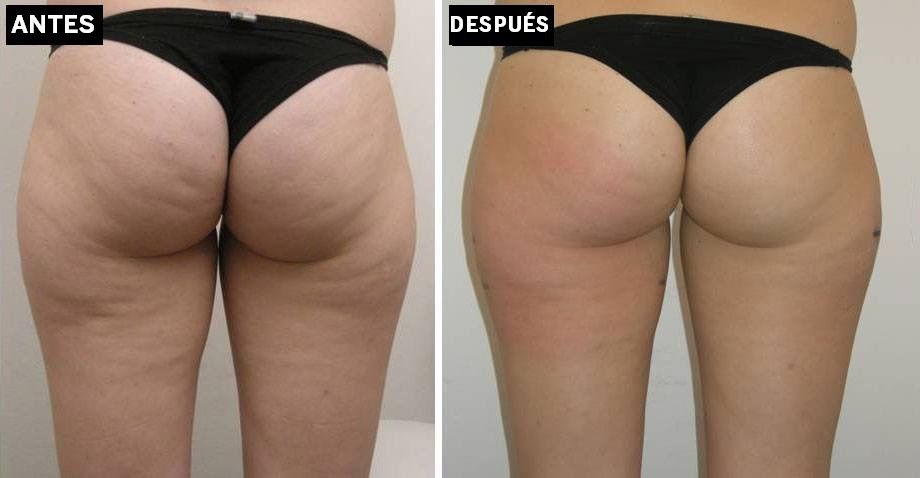 fotos criolipolisis de antes y despues de su aplicacion
