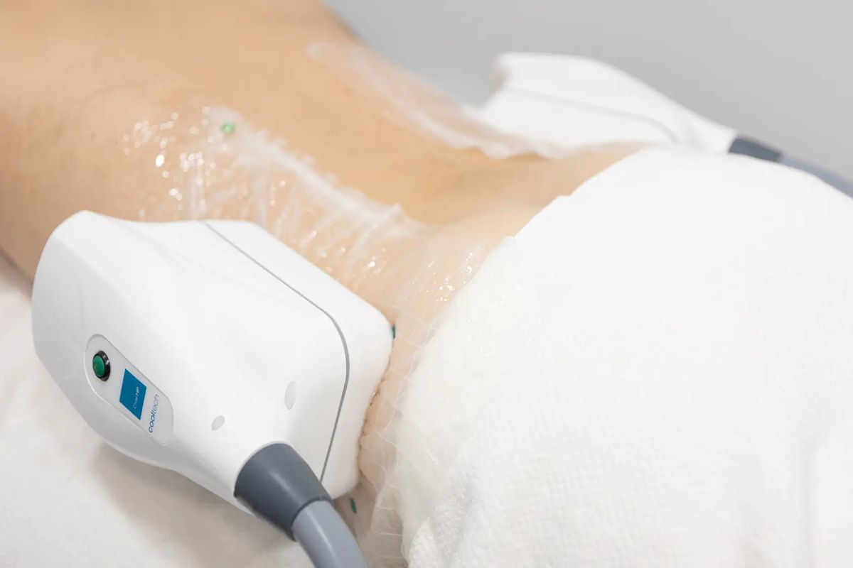 resultados de la criolipolisis, funciona realmente