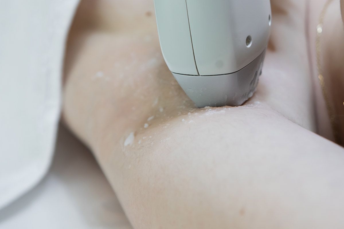depilacion-laser-axilas-hombres depilacion laser axilas hombres